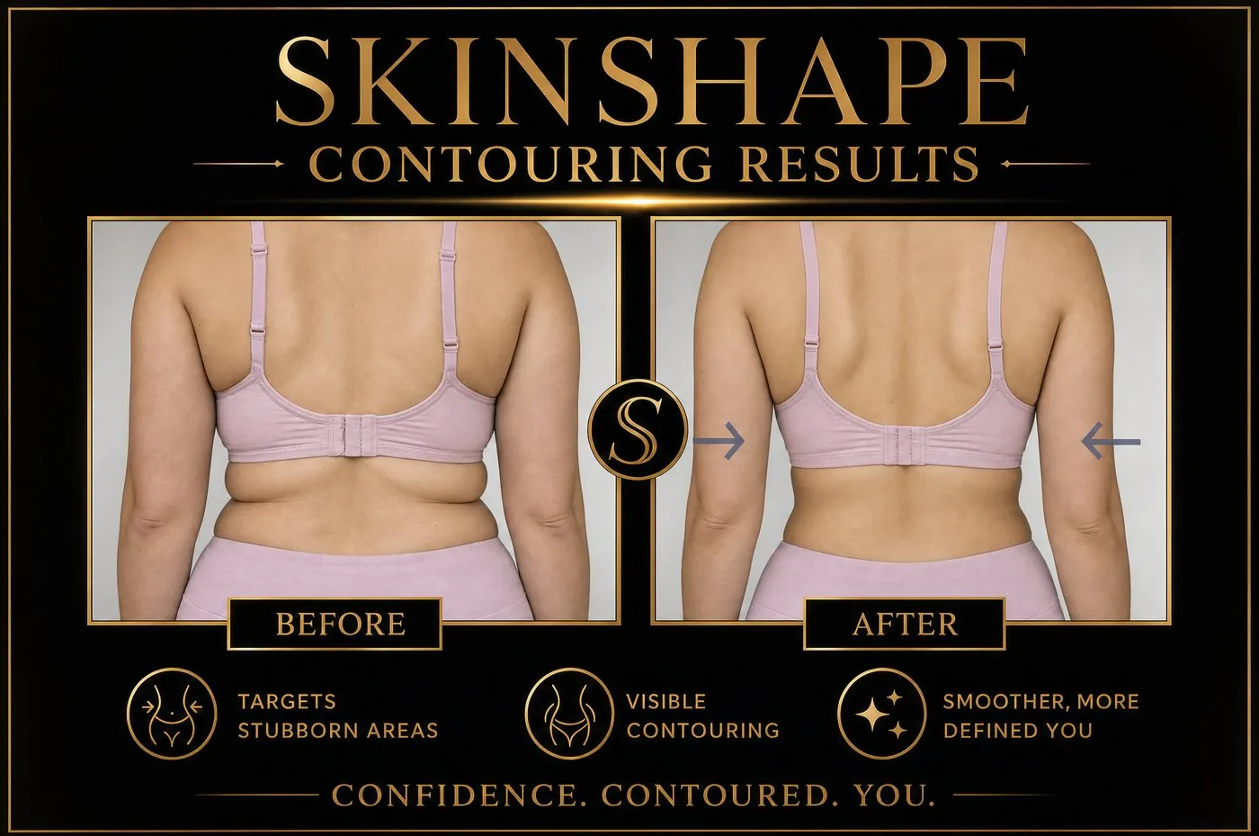 SKINSHAPE® before and after — Bra Fat & Upper Back