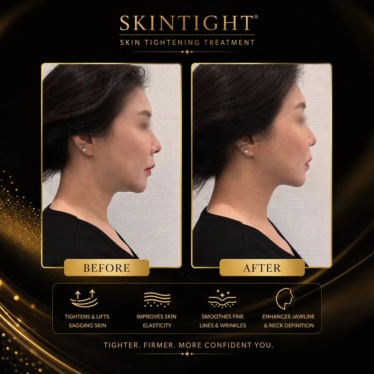SKINTIGHT® Before & After — Neck and jawline tightening, female client