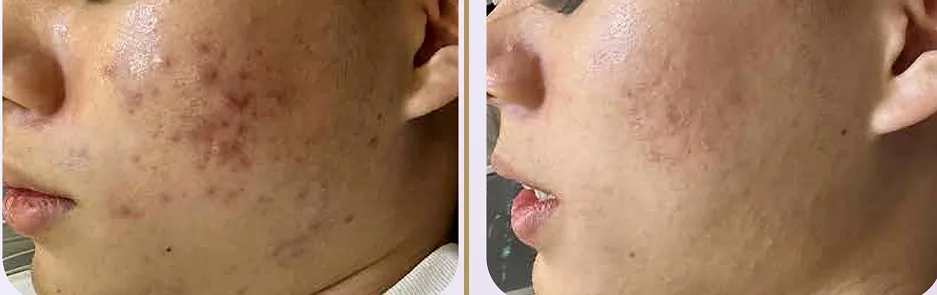SKINLDM® Before and After — Acne and inflammation treatment result