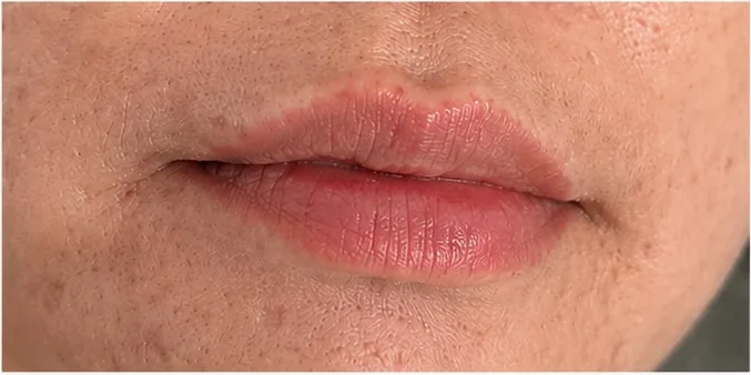 漂唇前 —— 天生唇色不均、唇线柔和不明显,SkinRev Lab 新加坡
