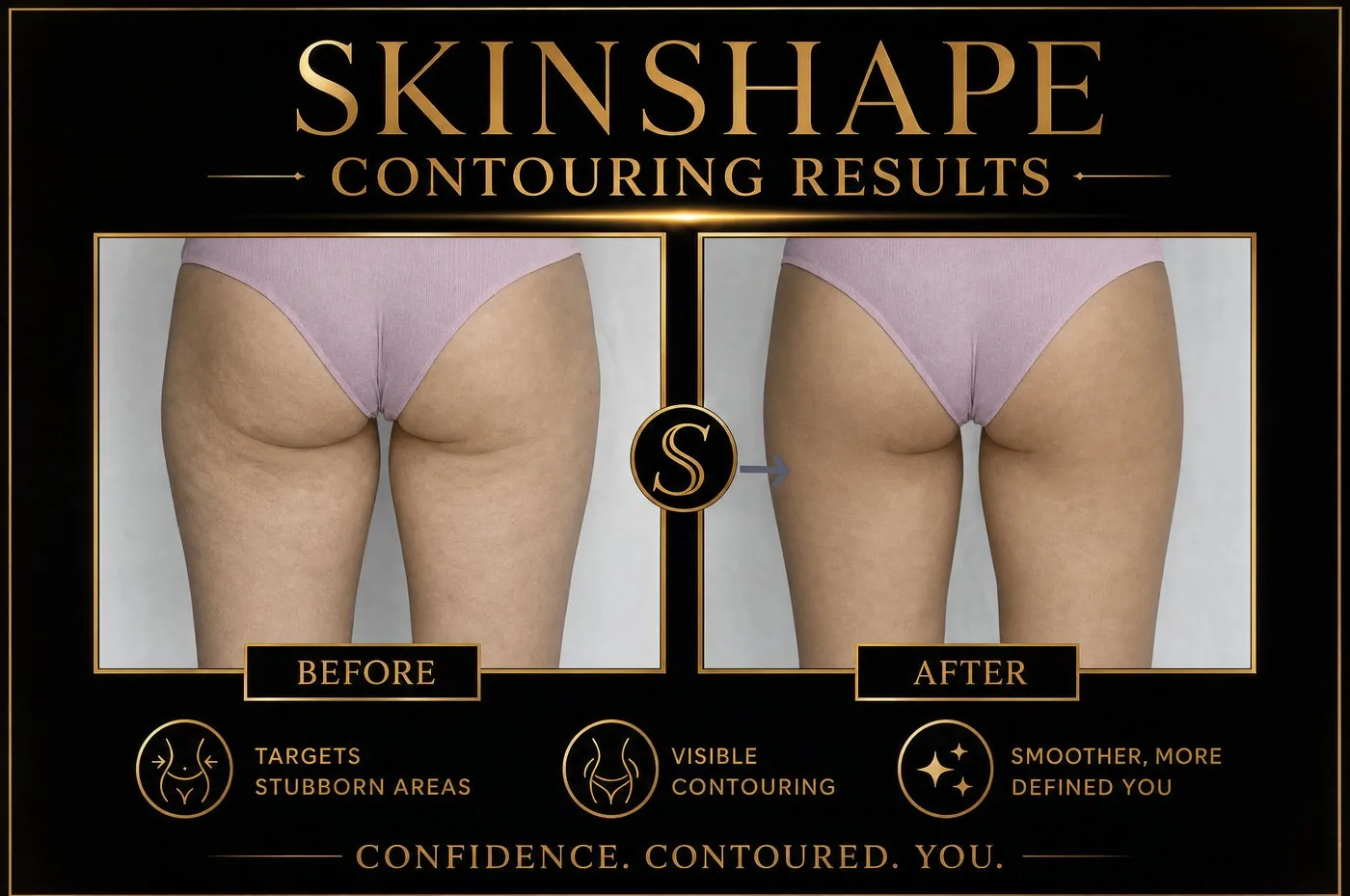 SKINSHAPE® before and after — Thighs & Buttocks
