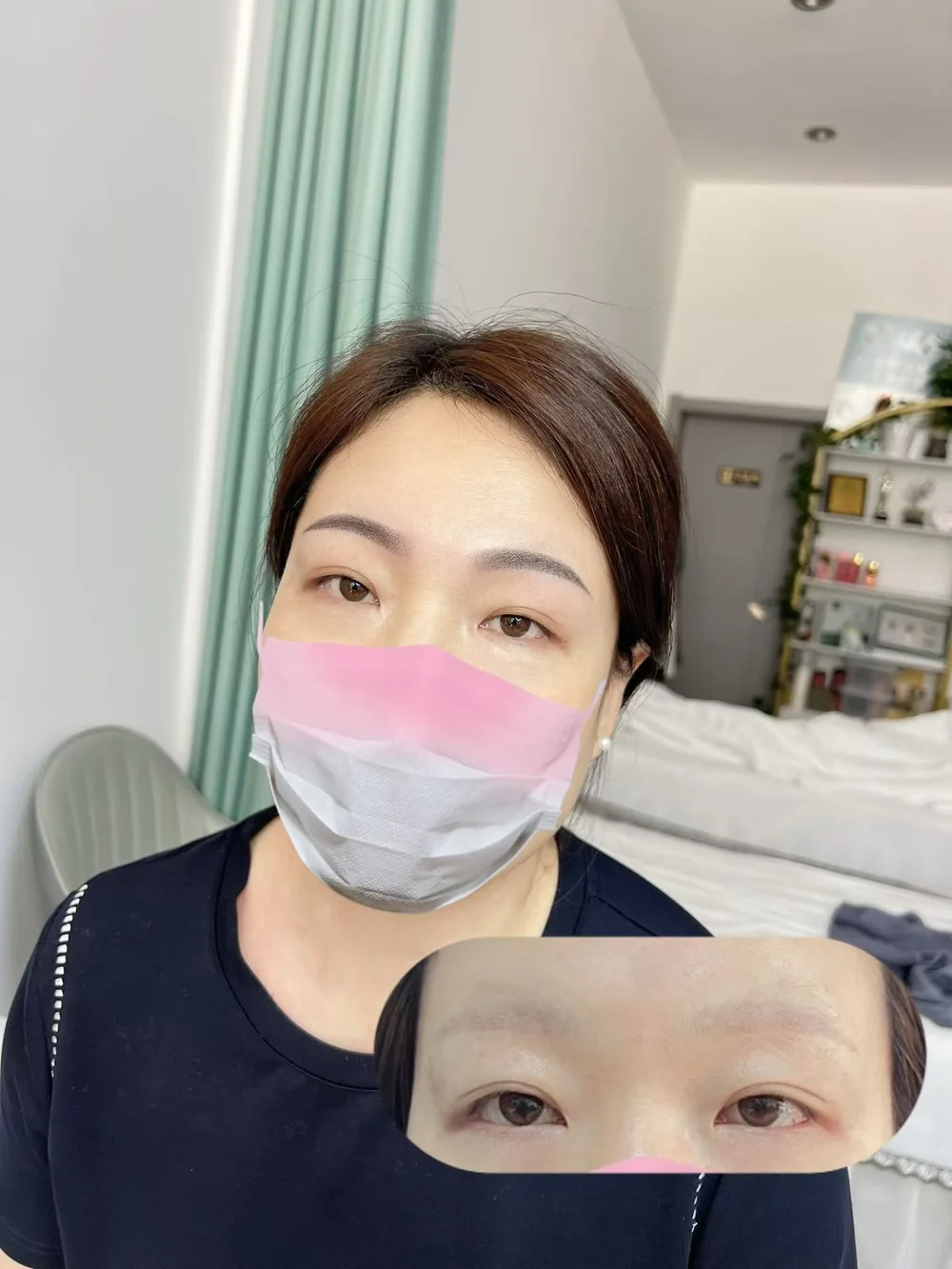 Eyebrow embroidery result, both brows matched, SkinRev Lab Singapore