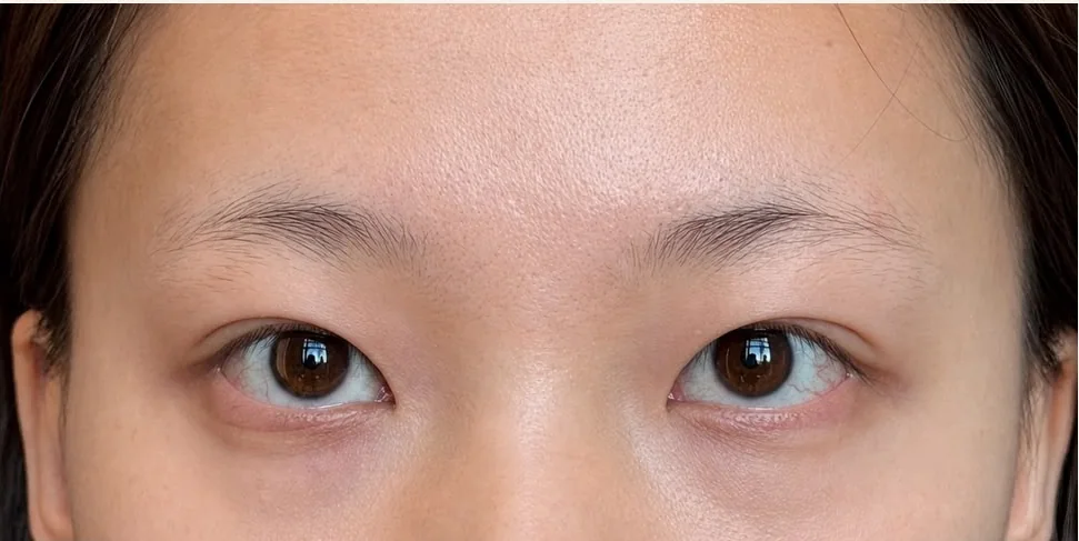 Eyebrow embroidery before at eye level, SkinRev Lab Singapore