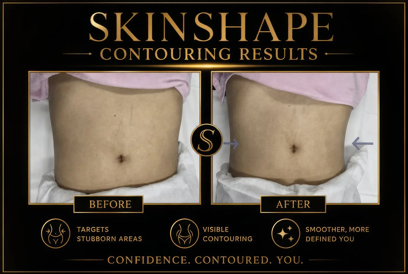 SKINSHAPE® before and after — Tummy / Abdomen