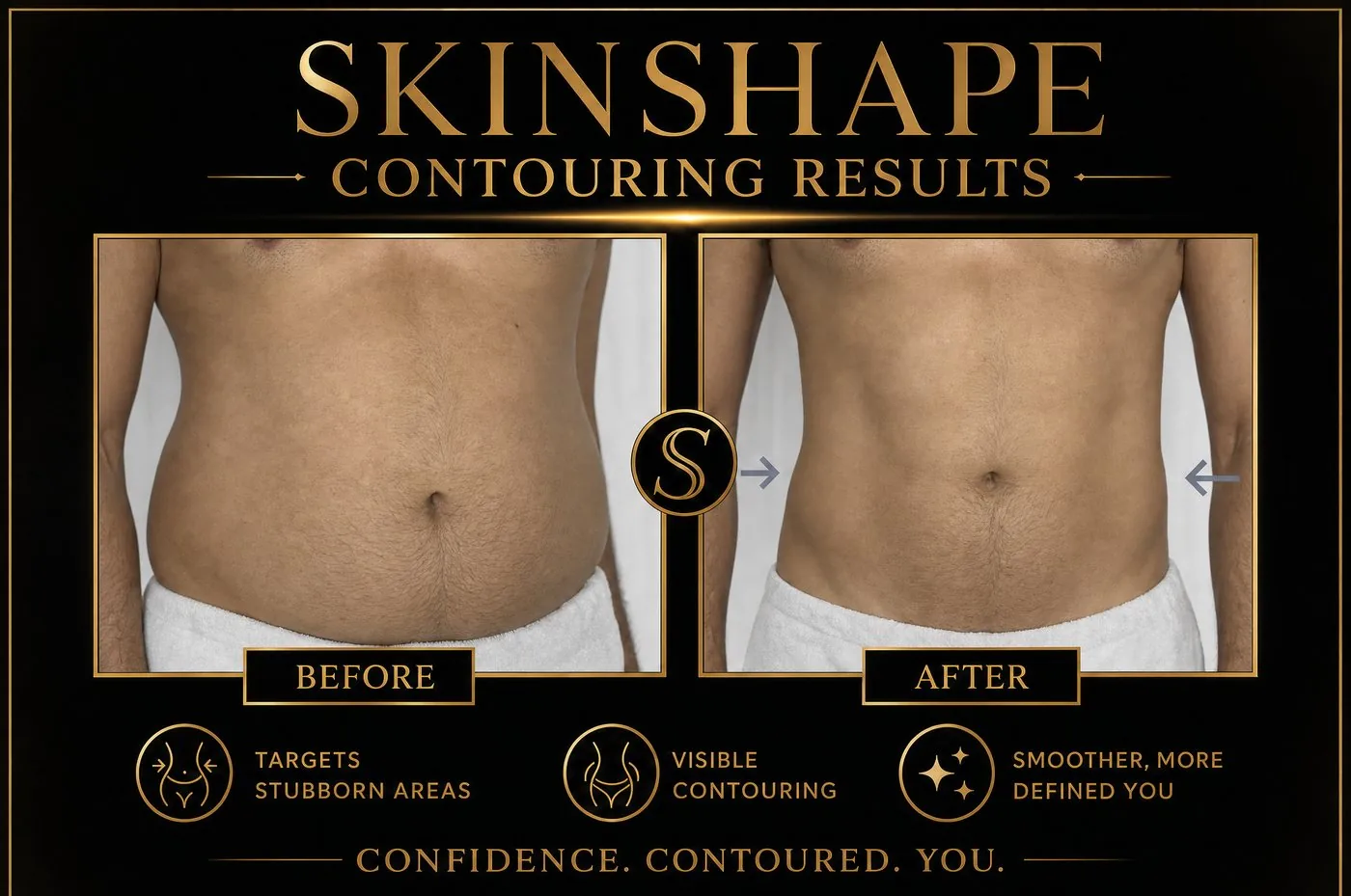 SKINSHAPE® before and after — Men's Tummy Sculpting