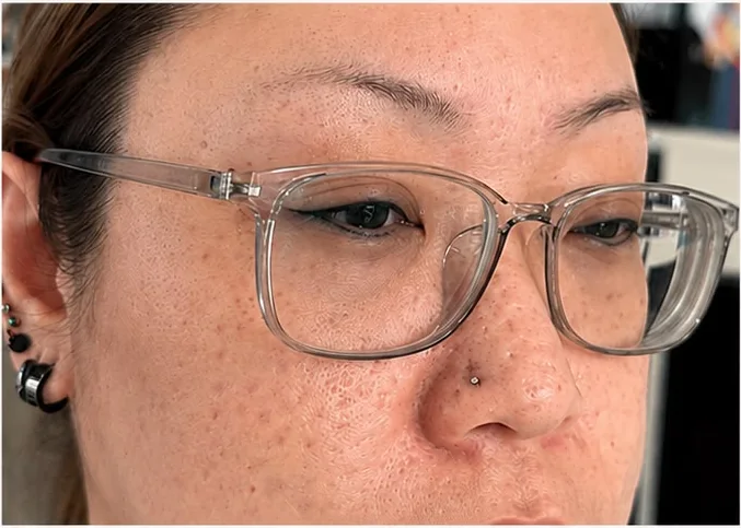 Eyebrow embroidery before, faint sparse brow, SkinRev Lab Singapore