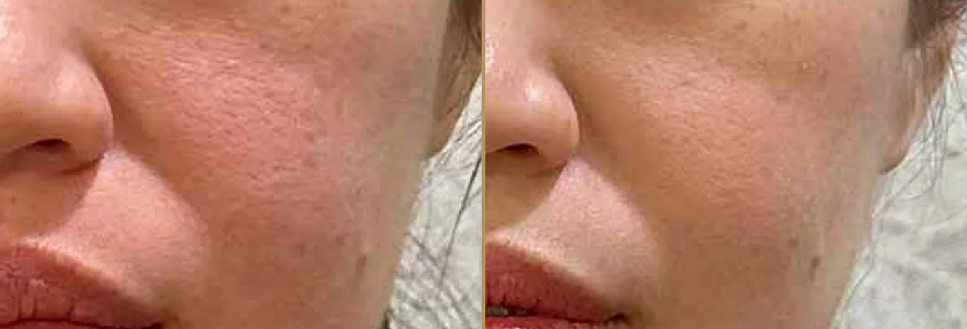 SKINLDM® Before and After — Enlarged pores and skin texture refinement