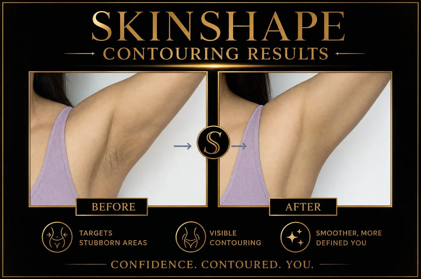 SKINSHAPE® before and after — Bat Wings / Arms