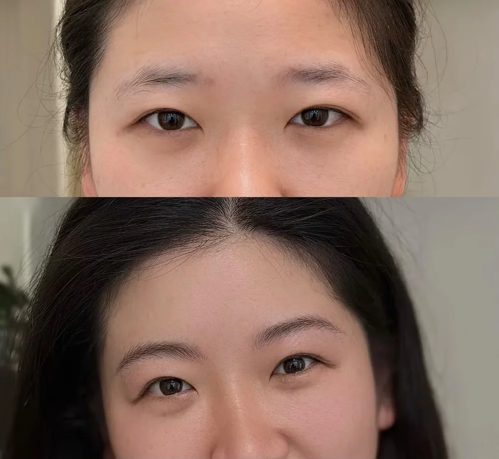 Eyebrow embroidery healed result, close view, SkinRev Lab Singapore