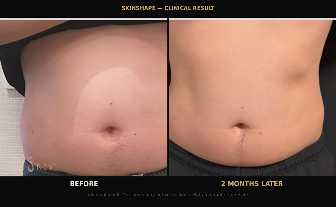 SKINSHAPE body contouring result showing reduced abdominal fat and a flatter, firmer stomach contour two months after treatment