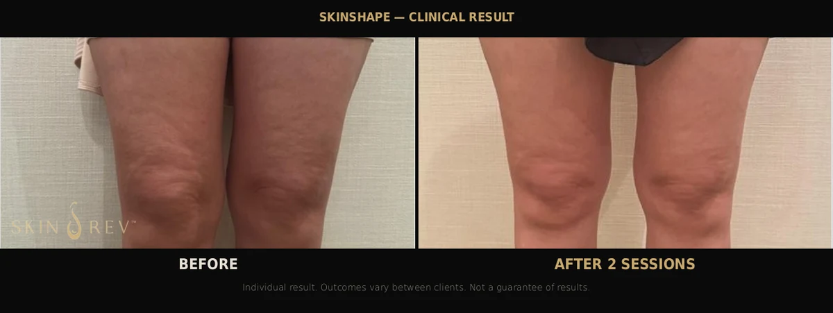 SKINSHAPE cellulite reduction result showing smoother thigh texture and reduced dimpling after two sessions