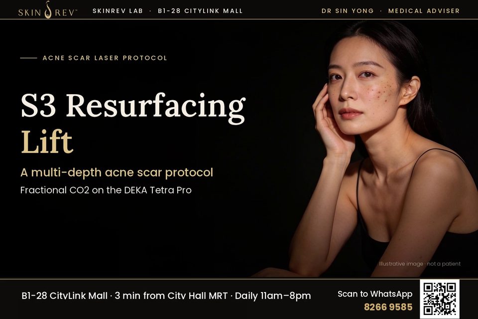 Acne Scar Laser Singapore: S3 Resurfacing Lift on the DEKA Tetra Pro