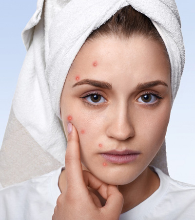 Acne Facial